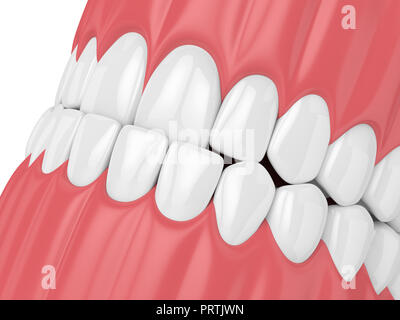 3D render della ganascia malocclusioni con underbite. Denti superiori dietro i denti inferiori Foto Stock