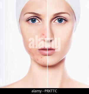 Volto di donna bella con problema acne pelle e pelle chiara Foto Stock