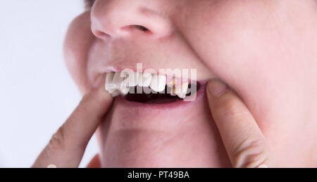 Donna matura con la bocca aperta e dente rotto Foto Stock