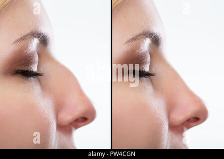 Confronto della donna di naso prima e dopo un intervento di chirurgia plastica Foto Stock