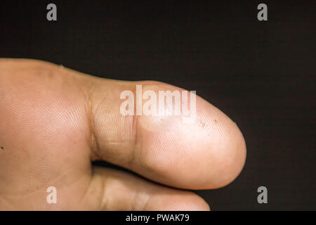 Blister sulla pelle Foto Stock