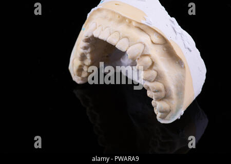 Modello in cera denti corone dentali sul modello, priva di metallo - Vista anteriore .Ceramic anteriore impiallacciature isolati su sfondo nero. Metal-Ceramic corone sul modello in gesso nel laboratorio dentale. Foto Stock