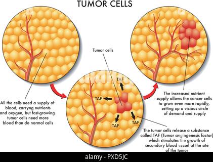 Vettore Illustrazione medica della formazione di cellule tumorali Illustrazione Vettoriale