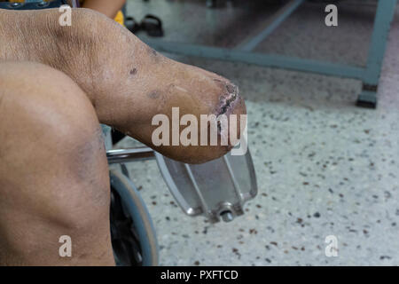 Al di sotto del ginocchio amputazione, chiudere fino a sinistra il moncone di pazienti diabetici con post amputato funzionamento Foto Stock