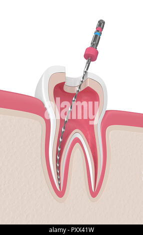 3D render del dente con file endodontico in le gengive. Trattamento canalare concetto. Foto Stock