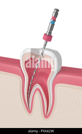 3D render del dente con file endodontico in le gengive. Trattamento canalare concetto. Foto Stock