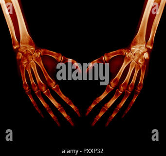 X-ray immagine - palme umana ripiegata in una forma di cuore Foto Stock