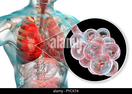 Una polmonite batterica. Computer illustrazione di a forma di asta (batteri bacilli) negli alveoli dei polmoni, causando una infezione dell'apparato respiratorio inferiore. Questo è più generalmente noto come polmonite, sebbene tale termine può anche essere riservati per specifici tipi di infezione. Gravi infezioni polmonari sono diagnosticati da raggi X e trattati con antibiotici. Gli alveoli sono il sito di scambio gassoso tra l'aria nei polmoni e nel sangue. Foto Stock