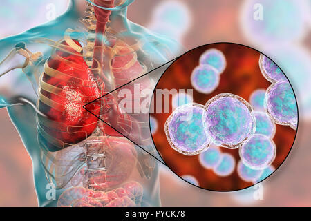 Polmonite causata da batteri di Moraxella catarrhalis, illustrazione del computer. Moraxella () Branhamella catarrhalis sono aerobiche, Gram-negativi cocchi (sferica batteri). Essi sono comunemente presenti nelle membrane mucose dell'apparato respiratorio dei mammiferi, compresi gli esseri umani. In individui immunocompromessi o opportunistico, essi possono causare infezioni del tratto respiratorio, inclusi polmonite. Foto Stock