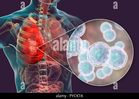 Polmonite causata da batteri di Moraxella catarrhalis, illustrazione del computer. Moraxella () Branhamella catarrhalis sono aerobiche, Gram-negativi cocchi (sferica batteri). Essi sono comunemente presenti nelle membrane mucose dell'apparato respiratorio dei mammiferi, compresi gli esseri umani. In individui immunocompromessi o opportunistico, essi possono causare infezioni del tratto respiratorio, inclusi polmonite. Foto Stock
