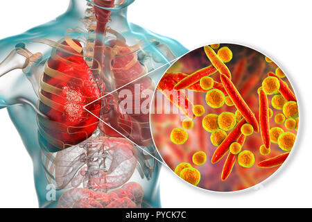 La polmonite causata da Mycoplasma pneumoniae batteri, concettuale illustrazione del computer. I micoplasmi sono i più piccoli organismi cellulari noto (diametro Foto Stock