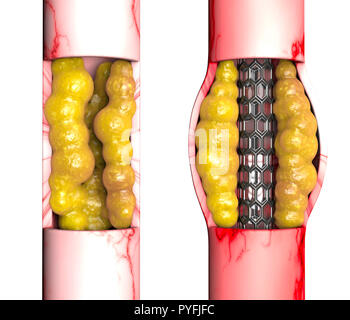 Chirurgia di bypass delle arterie coronarie è una procedura chirurgica per ripristinare il normale flusso sanguigno ad un ostacolato arteria coronaria. Cuore e di attacco di cuore Foto Stock