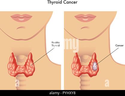 Illustrazione medica degli effetti del cancro della tiroide Illustrazione Vettoriale