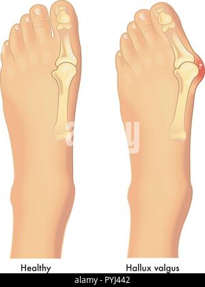 Medical illustrazione vettoriale di un piede sano in confronto a un piede apposta da alluce valgo Illustrazione Vettoriale