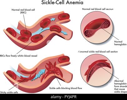 Illustrazione medica degli effetti di anemia falciforme Illustrazione Vettoriale