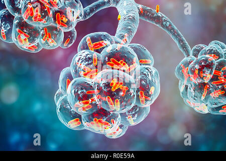 Una polmonite batterica. Computer illustrazione di a forma di asta (batteri bacilli) negli alveoli dei polmoni, causando una infezione dell'apparato respiratorio inferiore. Questo è più generalmente noto come polmonite, sebbene tale termine può anche essere riservati per specifici tipi di infezione. Gravi infezioni polmonari sono diagnosticati da raggi X e trattati con antibiotici. Gli alveoli sono il sito di scambio gassoso tra l'aria nei polmoni e nel sangue. Foto Stock