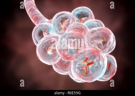 Una polmonite batterica. Computer illustrazione di a forma di asta (batteri bacilli) negli alveoli dei polmoni, causando una infezione dell'apparato respiratorio inferiore. Questo è più generalmente noto come polmonite, sebbene tale termine può anche essere riservati per specifici tipi di infezione. Gravi infezioni polmonari sono diagnosticati da raggi X e trattati con antibiotici. Gli alveoli sono il sito di scambio gassoso tra l'aria nei polmoni e nel sangue. Foto Stock