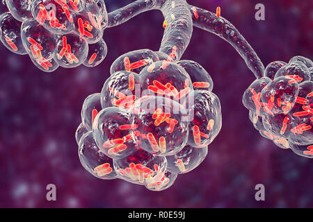 Una polmonite batterica. Computer illustrazione di a forma di asta (batteri bacilli) negli alveoli dei polmoni, causando una infezione dell'apparato respiratorio inferiore. Questo è più generalmente noto come polmonite, sebbene tale termine può anche essere riservati per specifici tipi di infezione. Gravi infezioni polmonari sono diagnosticati da raggi X e trattati con antibiotici. Gli alveoli sono il sito di scambio gassoso tra l'aria nei polmoni e nel sangue. Foto Stock