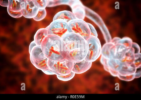 Una polmonite batterica. Computer illustrazione di a forma di asta (batteri bacilli) negli alveoli dei polmoni, causando una infezione dell'apparato respiratorio inferiore. Questo è più generalmente noto come polmonite, sebbene tale termine può anche essere riservati per specifici tipi di infezione. Gravi infezioni polmonari sono diagnosticati da raggi X e trattati con antibiotici. Gli alveoli sono il sito di scambio gassoso tra l'aria nei polmoni e nel sangue. Foto Stock