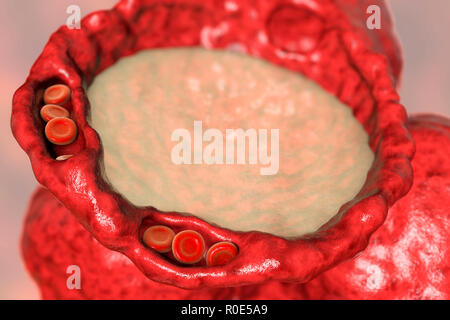 Edema polmonare, illustrazione del computer. I capillari sono ormai congestionati con globuli rossi (eritrociti, round) e dilatato, e gli alveoli (spazi di aria) hanno riempito con fluido. La presenza di fluido nei polmoni interferisce con lo scambio gassoso, determinando affanno, ansia e può portare molto rapidamente per arresto respiratorio e morte. Edema polmonare è più spesso causato da insufficienza cardiaca, ma può anche essere causato da insufficienza renale. Foto Stock