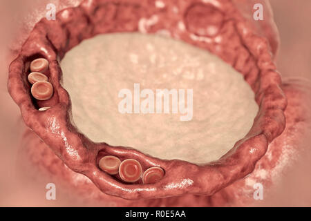 Edema polmonare, illustrazione del computer. I capillari sono ormai congestionati con globuli rossi (eritrociti, round) e dilatato, e gli alveoli (spazi di aria) hanno riempito con fluido. La presenza di fluido nei polmoni interferisce con lo scambio gassoso, determinando affanno, ansia e può portare molto rapidamente per arresto respiratorio e morte. Edema polmonare è più spesso causato da insufficienza cardiaca, ma può anche essere causato da insufficienza renale. Foto Stock