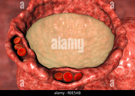 Edema polmonare, illustrazione del computer. I capillari sono ormai congestionati con globuli rossi (eritrociti, round) e dilatato, e gli alveoli (spazi di aria) hanno riempito con fluido. La presenza di fluido nei polmoni interferisce con lo scambio gassoso, determinando affanno, ansia e può portare molto rapidamente per arresto respiratorio e morte. Edema polmonare è più spesso causato da insufficienza cardiaca, ma può anche essere causato da insufficienza renale. Foto Stock