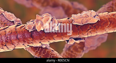 Capelli Umani con forfora, illustrazione del computer. Foto Stock