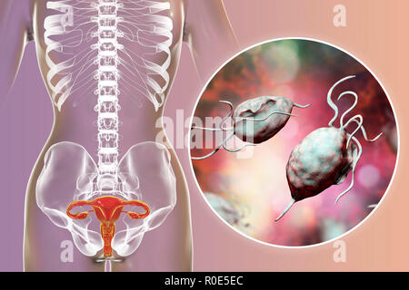 Trichomoniasis, illustrazione. Immagine del calcolatore del sistema riproduttivo femminile e il microrganismo parassita Trichomonas vaginalis, che è l'agente eziologico di trichomoniasis. Trichomoniasis è una causa comune di vaginite e è una malattia sessualmente trasmessa. Foto Stock