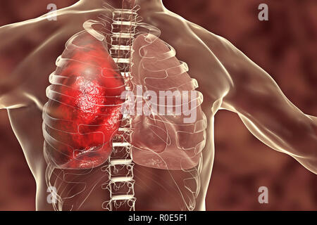 Polmonite, illustrazione. La polmonite è una condizione infiammatoria del polmone. Foto Stock