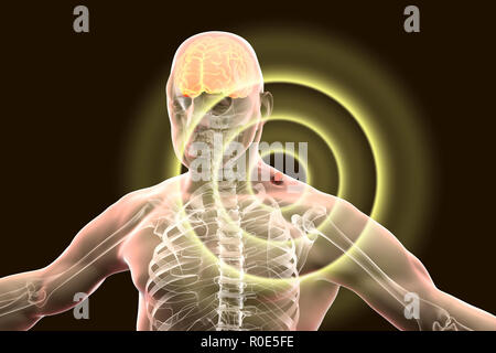 Tick-bourne encefalite, illustrazione del computer. Tick- sostenuti da encefalite (infiammazione del cervello) copre una vasta gamma di malattie che vanno da una grave encefalite paralitica, che si verifica in Siberia e viene trasmesso da Ixodes persulcatus, inferiore rispetto a quella di un paralitico encefalite, che si trova in Europa centrale e trasmesso da Ixodes ricinus. I lavoratori agricoli e forestali sono più frequentemente colpite, come i focolai di infezione sono in ed intorno a zone forestali, i vertebrati di host di manutenzione essendo roditori e la massa di uccelli viventi. Foto Stock