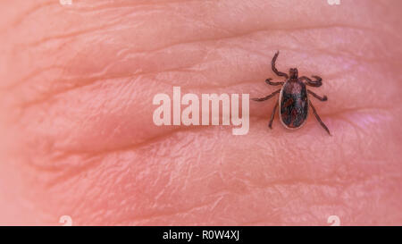 Cane bruno tick parassita. Pelle di close-up. Rhipicephalus sanguineus. Ixodida. Acaro infetti sulla stropicciata dito umano dettaglio. Tick-malattie portante. Foto Stock