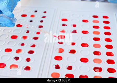 Determinazione in laboratorio del tipo di sangue. Esame del sangue. Foto Stock