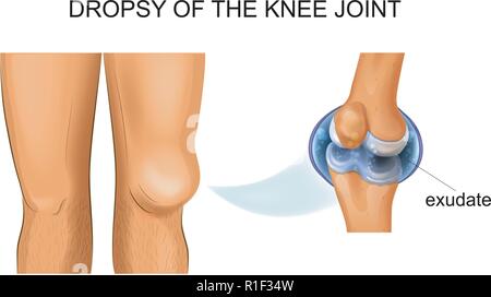 Illustrazione vettoriale del ginocchio hydrarthrosis, articolari idropisia Illustrazione Vettoriale