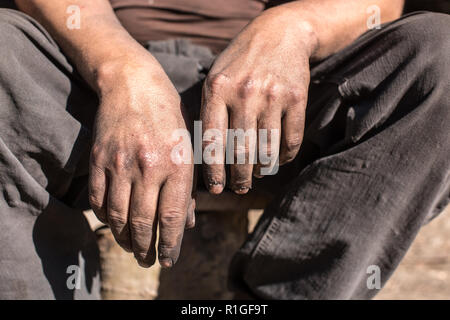 Lavoratore uomo con le mani sporche. Carbone-bruciatori lavoratore uomo con le mani sporche. Foto Stock