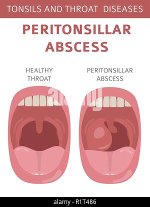 Le tonsille e malattie della gola. Peritonsillar ascesso sintomi, trattamento icon set. Infografico medica design. Illustrazione Vettoriale Illustrazione Vettoriale