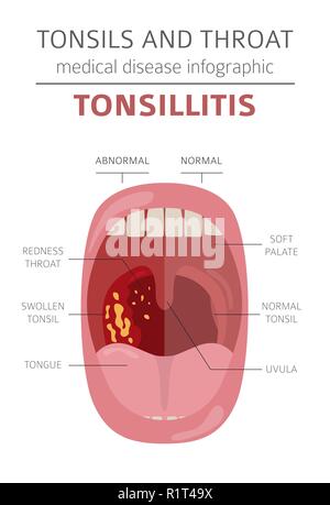 Le tonsille e malattie della gola. Tonsillite sintomi, trattamento icon set. Infografico medica design. Illustrazione Vettoriale Illustrazione Vettoriale