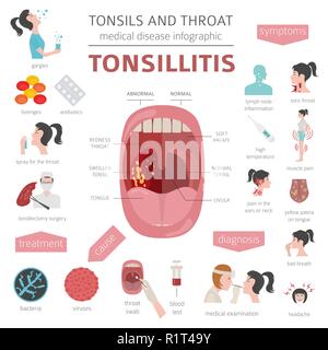 Le tonsille e malattie della gola. Tonsillite sintomi, trattamento icon set. Infografico medica design. Illustrazione Vettoriale Illustrazione Vettoriale