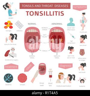 Le tonsille e malattie della gola. Tonsillite sintomi, trattamento icon set. Infografico medica design. Illustrazione Vettoriale Illustrazione Vettoriale