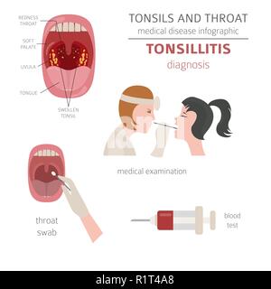 Le tonsille e malattie della gola. Tonsillite sintomi, trattamento icon set. Infografico medica design. Illustrazione Vettoriale Illustrazione Vettoriale