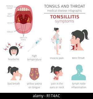 Le tonsille e malattie della gola. Tonsillite sintomi, trattamento icon set. Infografico medica design. Illustrazione Vettoriale Illustrazione Vettoriale