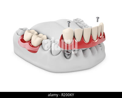 Anatomia di denti sani e impianto dentale in osso mandibolare. Stomatologia concetto 3d illustrazione Foto Stock