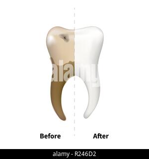 Dente umano con vecchi malati lato con la carie e di un bianco luminoso sano un altro, denti trattamento concetto dentale su bianco Illustrazione Vettoriale