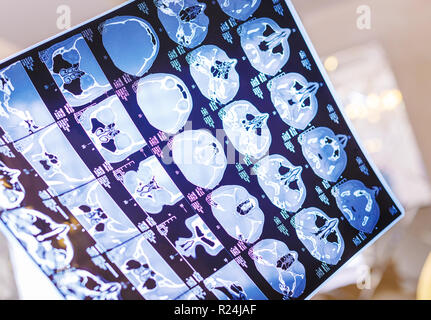 Pellicola a raggi x della testa tomografia computerizzata Foto Stock