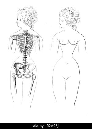 Vintage illustrazione di anatomia femminile della gabbia toracica deformazione dovuta all'uso di moda di corsetto Foto Stock