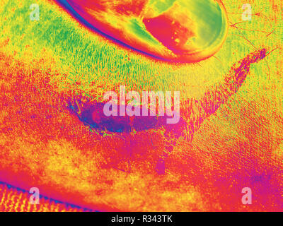 La cicatrice rosa sulla pelle umana. Cicatrice sul umano pelle bruciata dal abrassion scotti messa a fuoco selettiva. Hipster filtro. Foto Stock