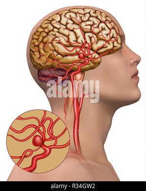 Aneurismas cerebrales Foto Stock