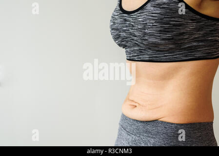 Ventre della donna dopo la dieta. Skinny fat concetto. Smagliature Foto Stock