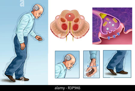 Il morbo di Parkinson è un tipo di disturbo del movimento. Si verifica quando i neuroni non producono abbastanza sostanza nota come dopamina. Foto Stock