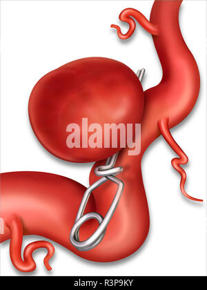 Clipping è la chirurgia di un aneurisma cerebrale in un'arteria. È la parete di un vaso sanguigno che lo fa rigonfiare e traboccare e può rompersi. Foto Stock