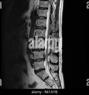 La mrt di una ernia del disco della colonna vertebrale lombare Foto Stock